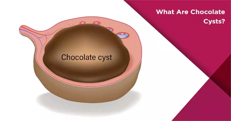 How is ruptured chocolate cyst dangerous?