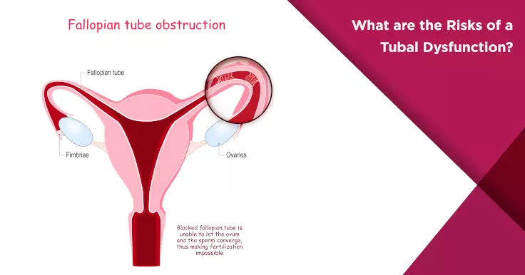 What are the Risks of Tubal Dysfunction Learn More Nova IVF