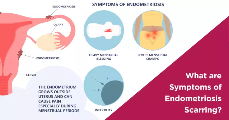 What are Symptoms of Endometriosis Scarring?