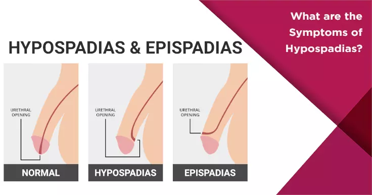 epispadias and hypospadias