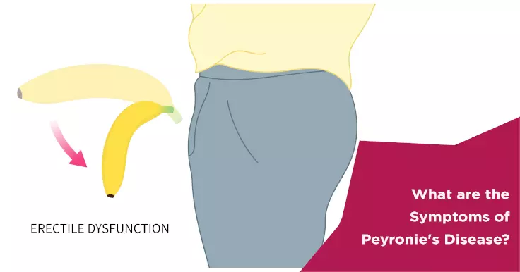 What are the Symptoms of Peyronie's Disease?
