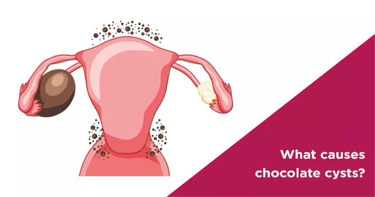 What causes chocolate cysts?