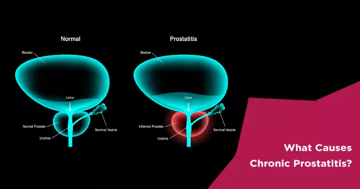 What Causes Chronic Prostatitis?