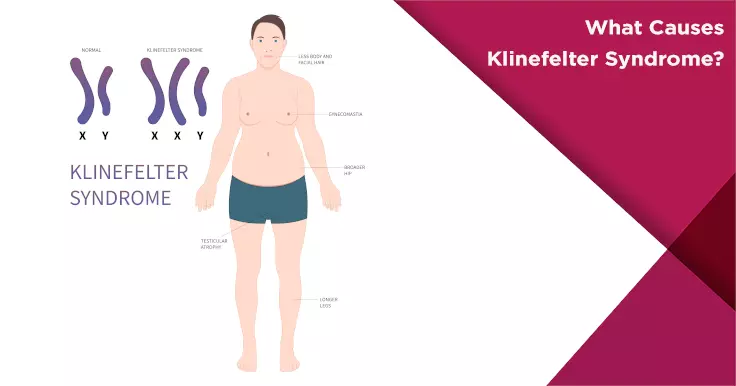 Solved syndrome causes males to have undeveloped testes