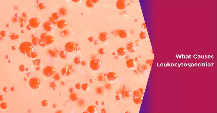 What Causes Leukocytospermia?