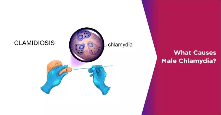 What Causes Male Chlamydia?