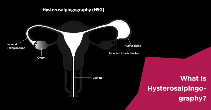What is Hysterosalpingography?