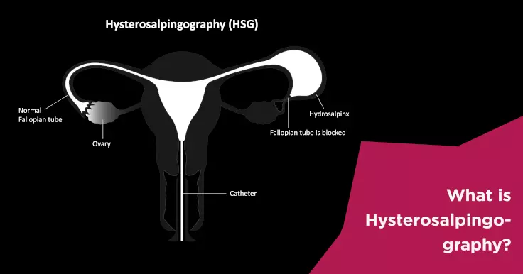 Hysterosalpingography Test: Everything You Need to Know HSG Test