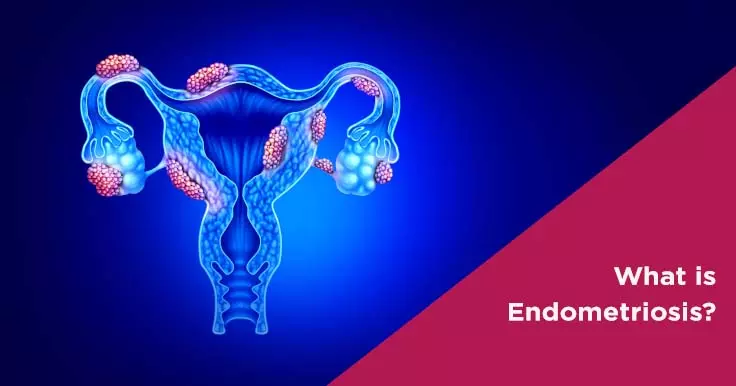 Meaning of Endometriosis and Its Stages