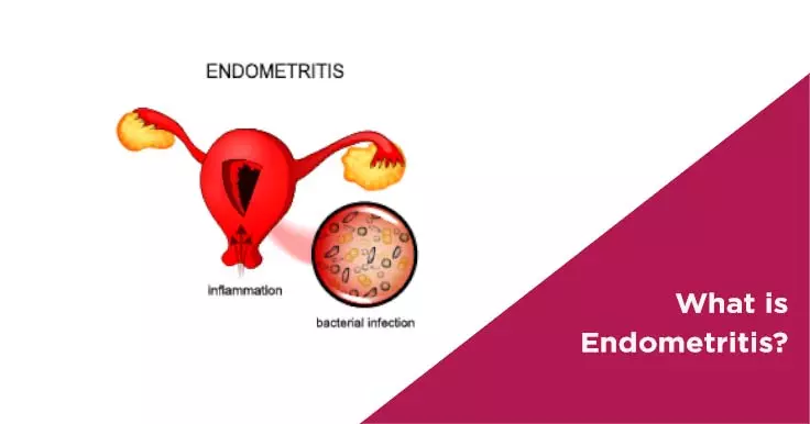 What is Endometritis?