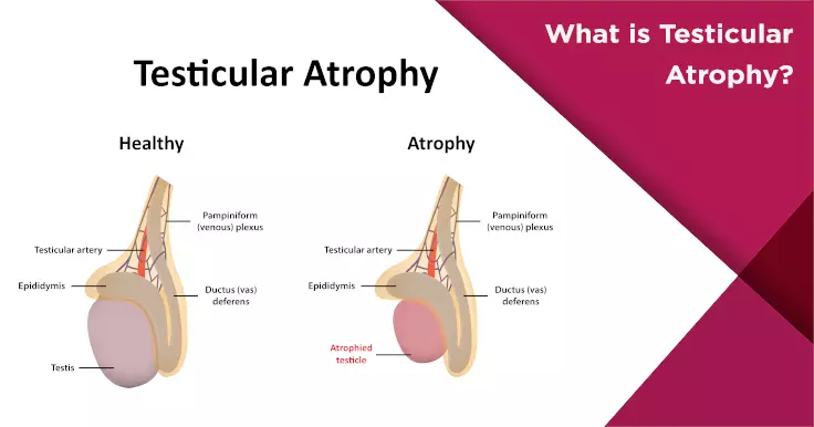 What is Testicular Atrophy?
