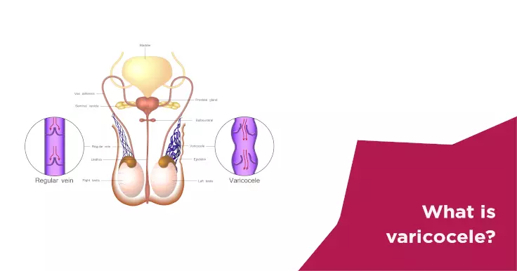 Treatment Comparison - Varicocele Embolization Specialist