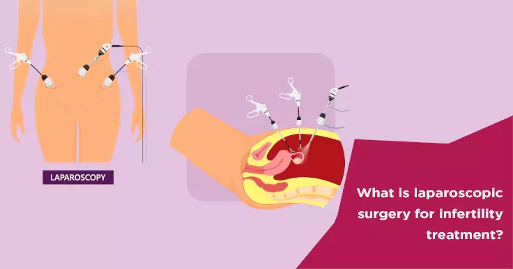 What is laparoscopic surgery for infertility treatment?