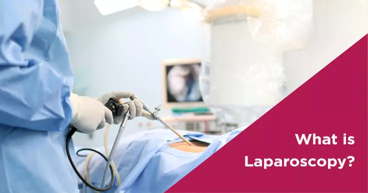 What is Laparoscopy?