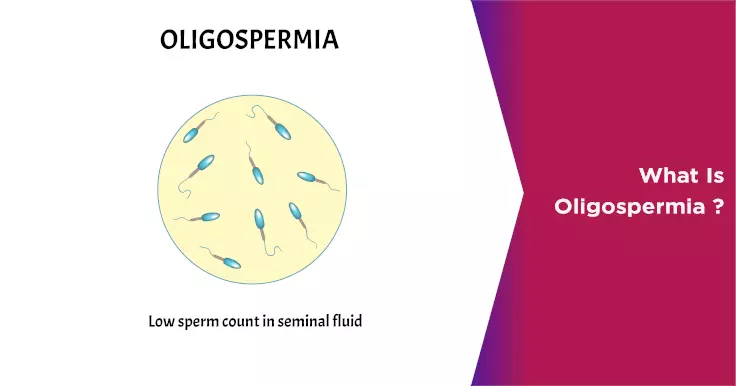 What is Oligospermia Causes Symptoms and Treatment Options