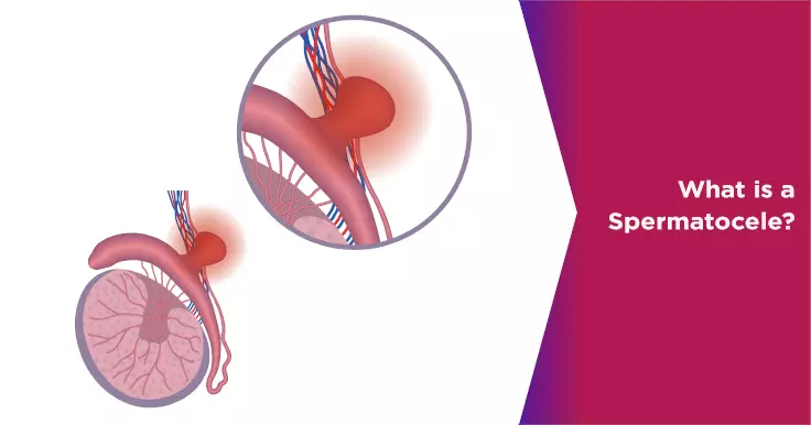 Spermatocele: Causes, Symptoms, Diagnosis & Treatment