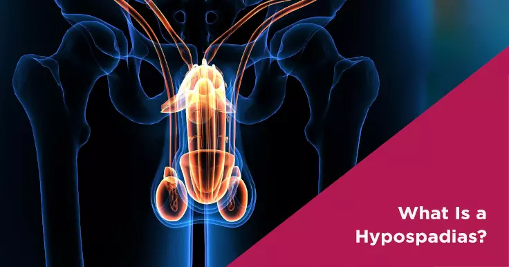 What Is a Hypospadias?