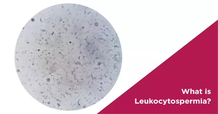 What is Leukocytospermia?