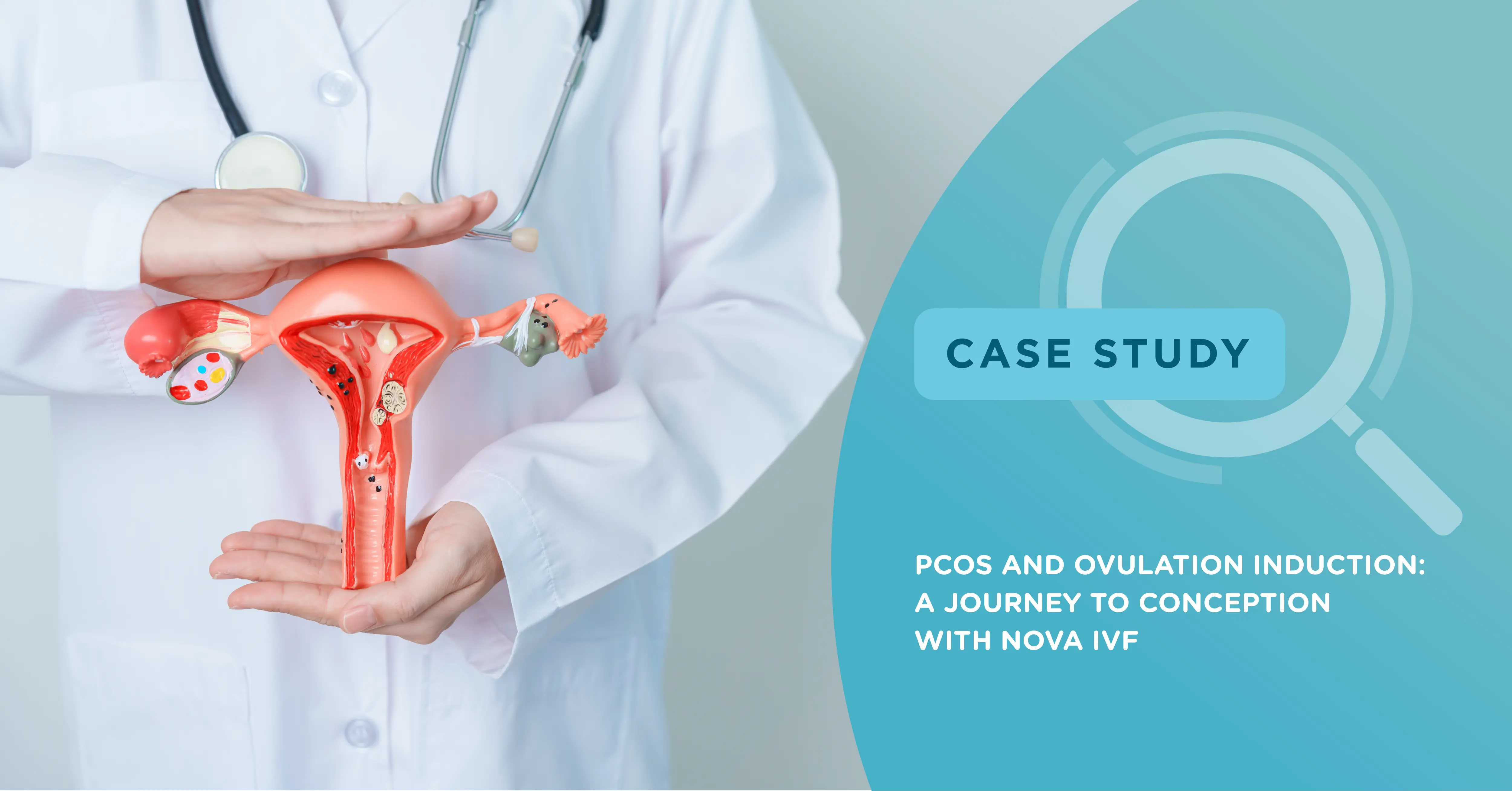 PCOS and Ovulation Induction: A Journey to Conception with Nova IVF