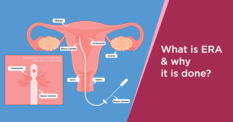 What Is the Endometrial Receptivity Array (ERA) Test?